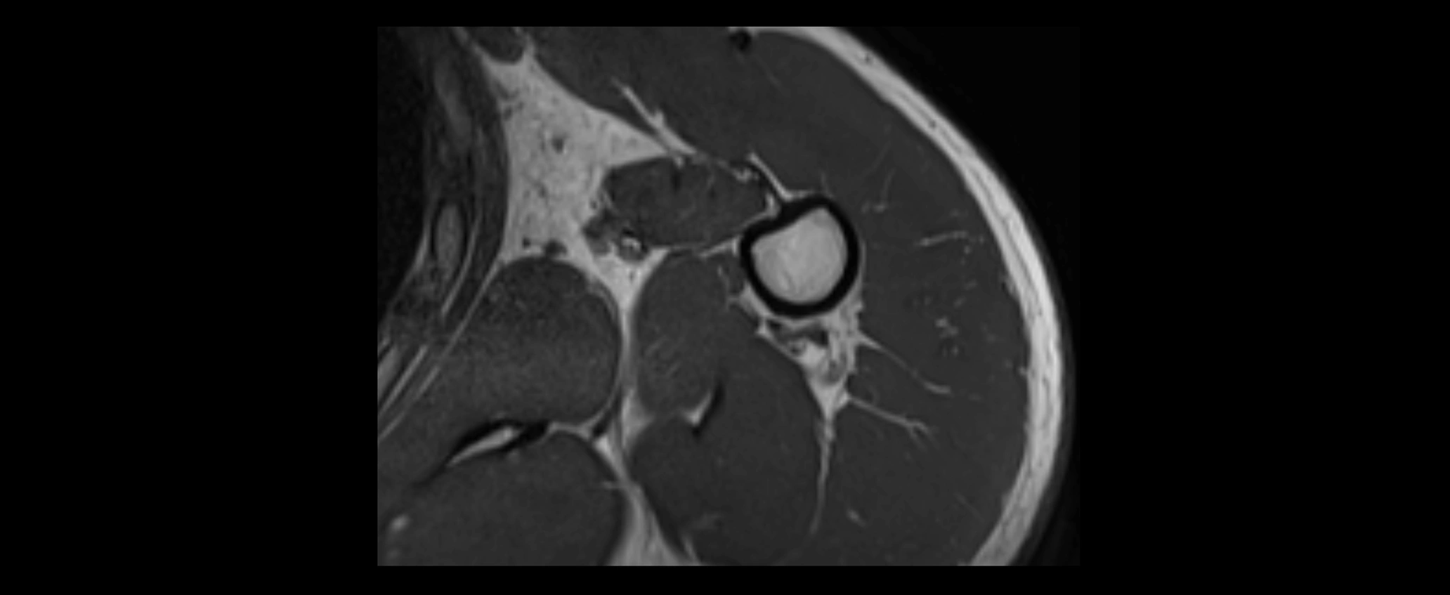 shoulder ligaments axial 3d 3t mri image-img-00005-00108.webp